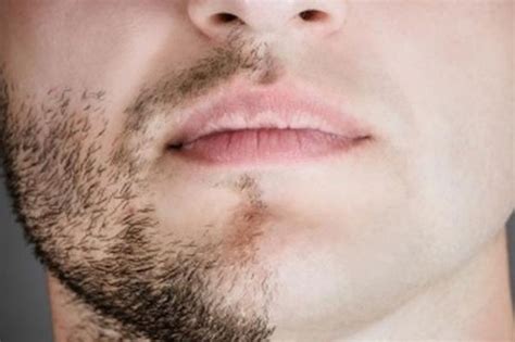 sakal epilasyonu zararları
